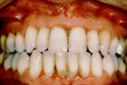Perfect Smile early periodontitis